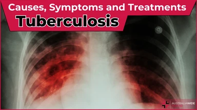 Tuberculosis article header – First Aid Article in Chatswood